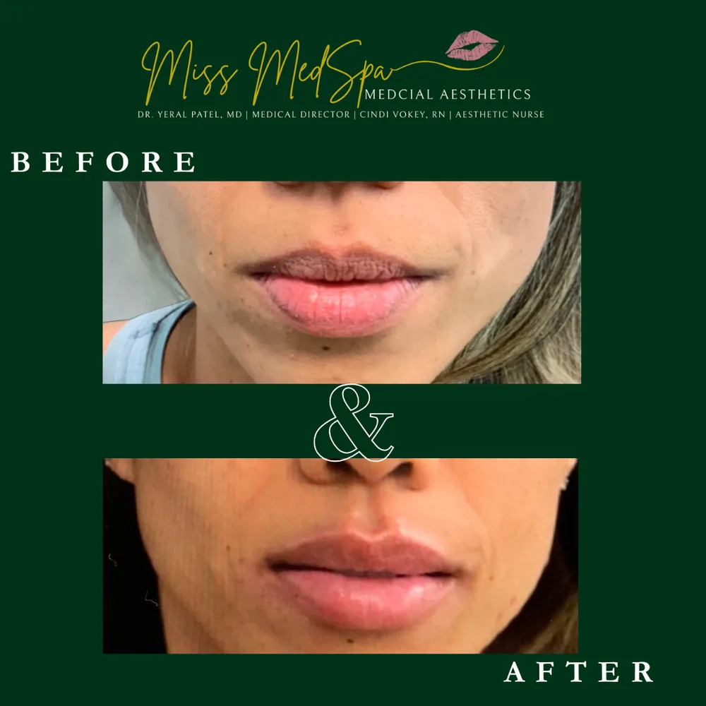 Before and after treatment at Miss MedSpa, example 1