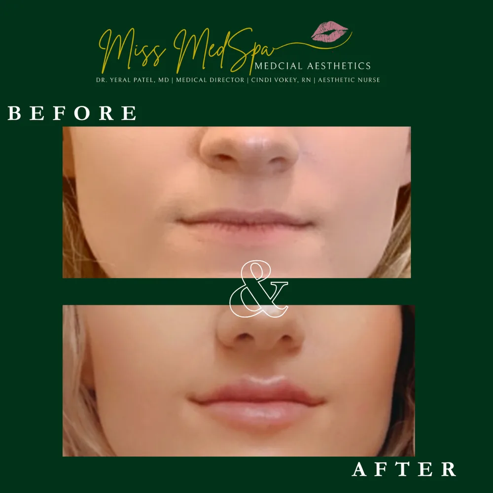 Before and after treatment at Miss MedSpa, example 2
