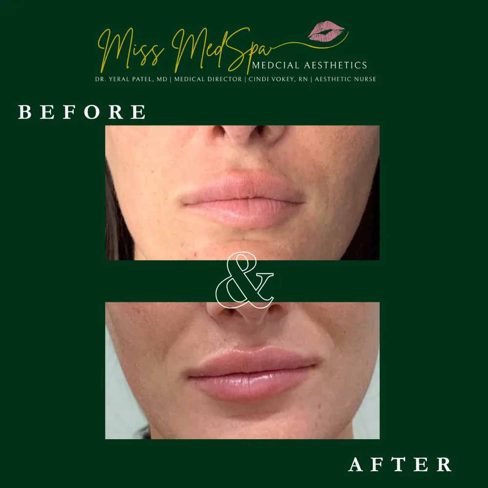 Before and after treatment at Miss MedSpa, example 3