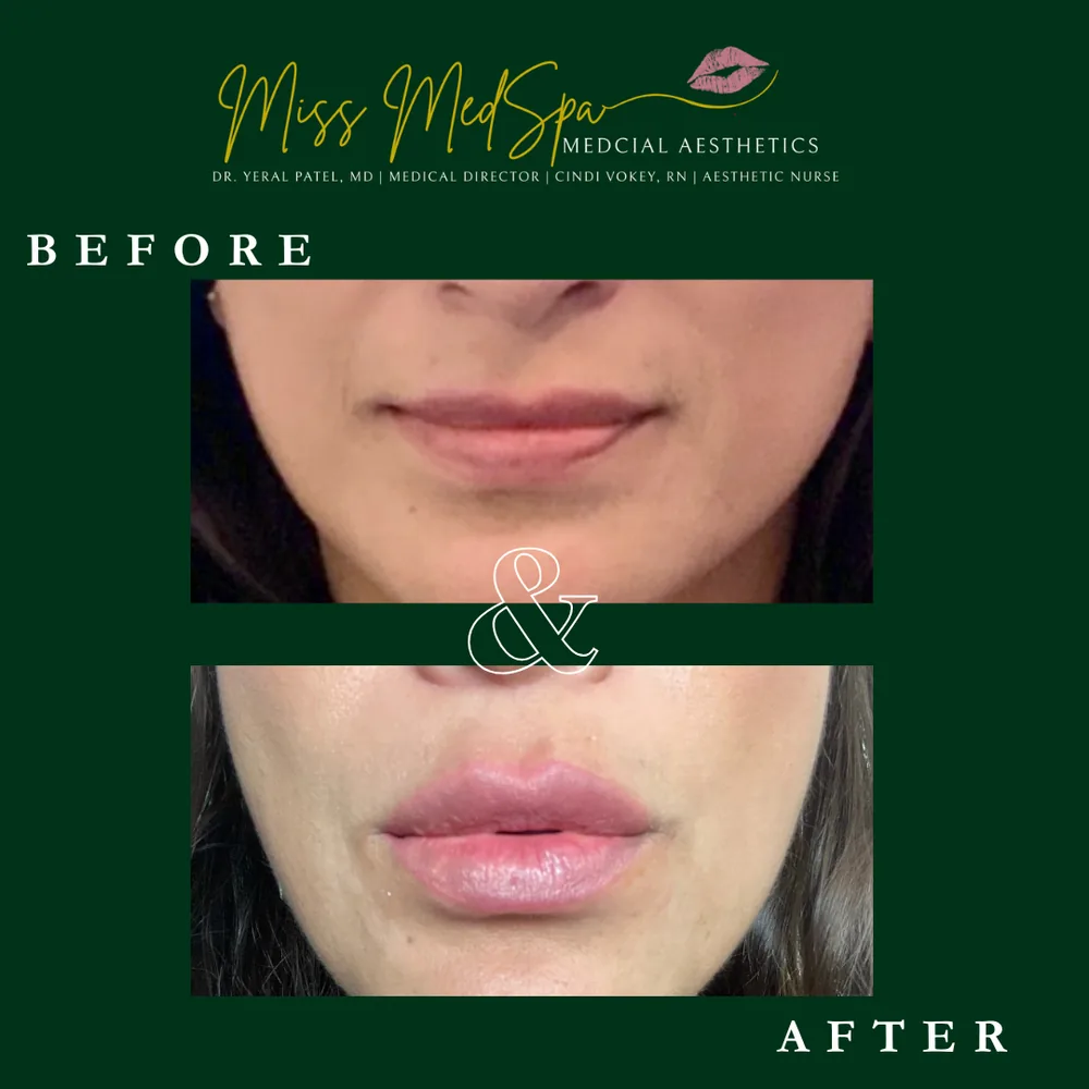 Before and after treatment at Miss MedSpa, example 4