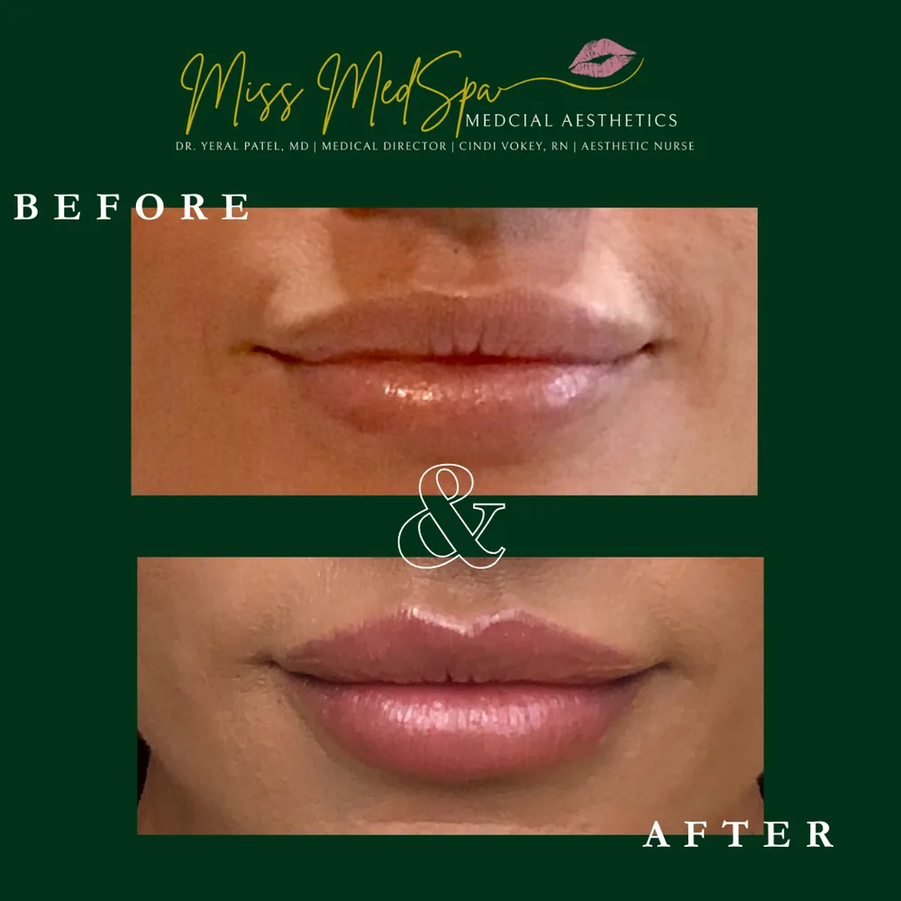 Before and after treatment at Miss MedSpa, example 5