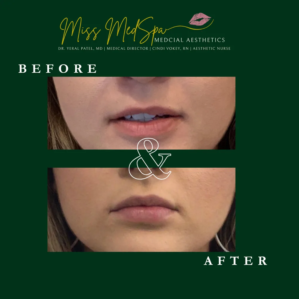 Before and after treatment at Miss MedSpa, example 6