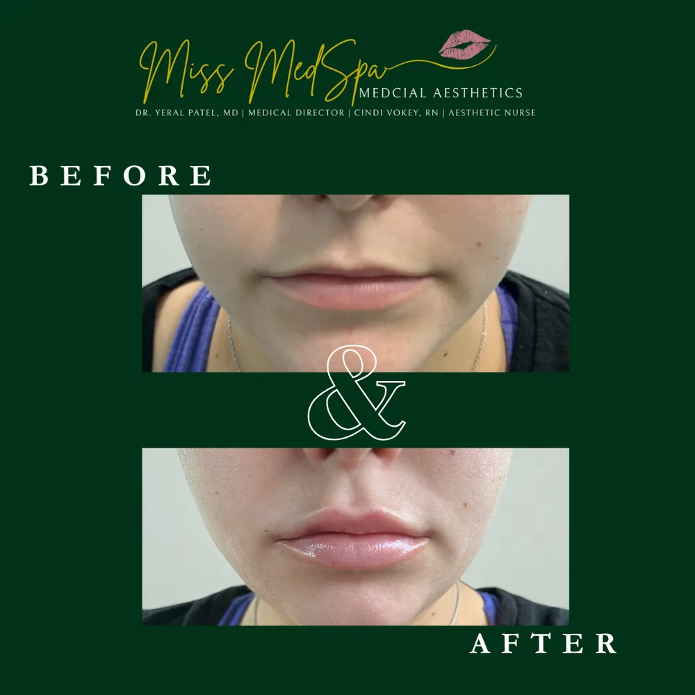 Before and after treatment at Miss MedSpa, example 7