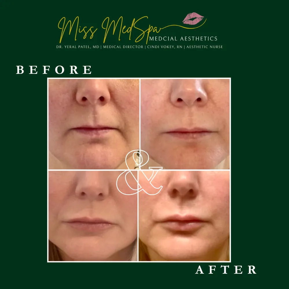 Before and after treatment at Miss MedSpa, example 8